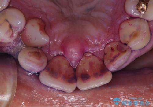 被せ物治療が終了したため全体的にクリーニングをの治療中