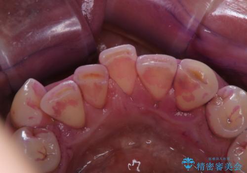 被せ物治療が終了したため全体的にクリーニングをの治療中