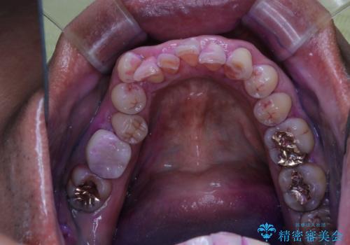 被せ物治療が終了したため全体的にクリーニングをの治療中