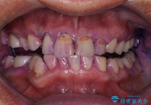 被せ物治療が終了したため全体的にクリーニングをの治療中