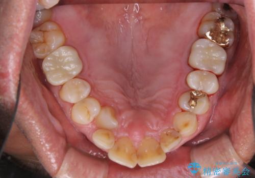 被せ物治療が終了したため全体的にクリーニングをの治療後