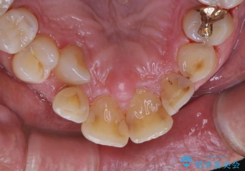 被せ物治療が終了したため全体的にクリーニングをの治療後