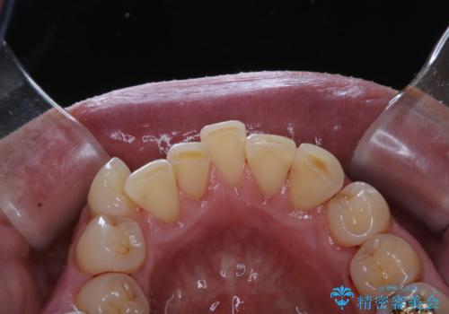 被せ物治療が終了したため全体的にクリーニングをの治療後