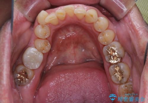 被せ物治療が終了したため全体的にクリーニングをの治療後