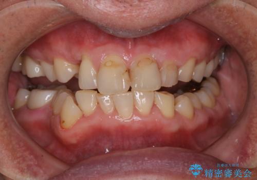 被せ物治療が終了したため全体的にクリーニングをの症例 治療後