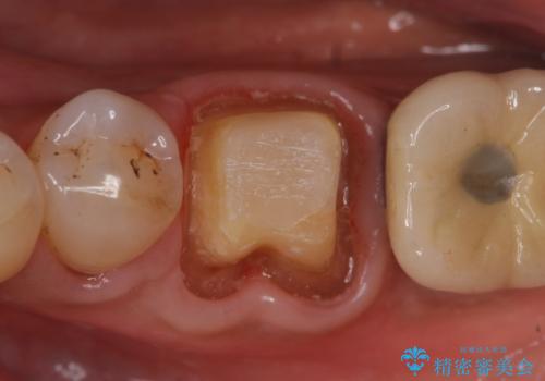 オールセラミッククラウン 咬むと痛む奥歯の根管治療の治療中