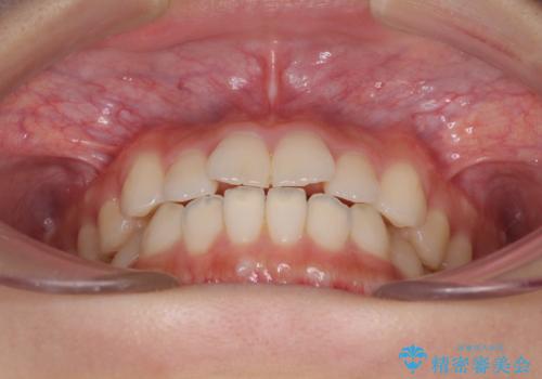 気になる前歯を整えたい インビザライン・ライトでの矯正治療の治療前