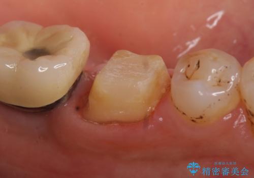オールセラミッククラウン 咬むと痛む奥歯の根管治療の治療中