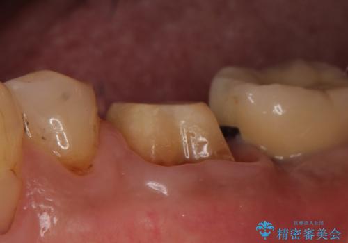 オールセラミッククラウン 咬むと痛む奥歯の根管治療の治療中