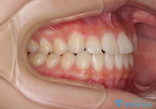 気になる前歯を整えたい インビザライン・ライトでの矯正治療の治療前