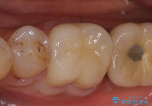 オールセラミッククラウン 咬むと痛む奥歯の根管治療の治療後