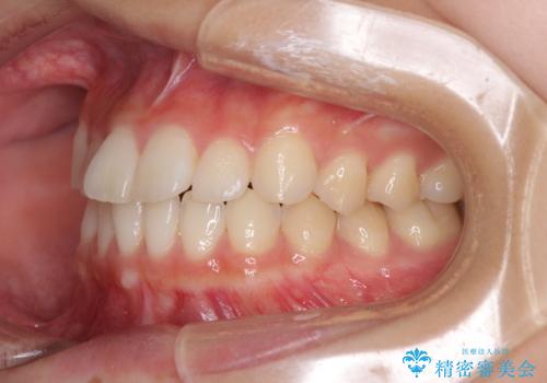 気になる前歯を整えたい インビザライン・ライトでの矯正治療の治療前