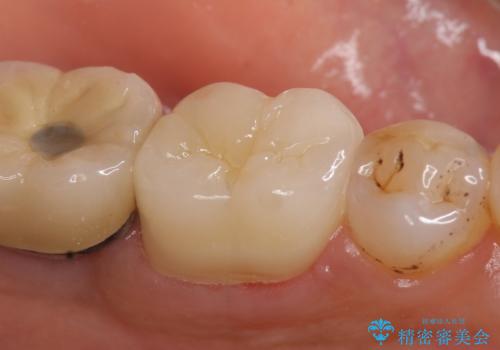 オールセラミッククラウン 咬むと痛む奥歯の根管治療の治療後
