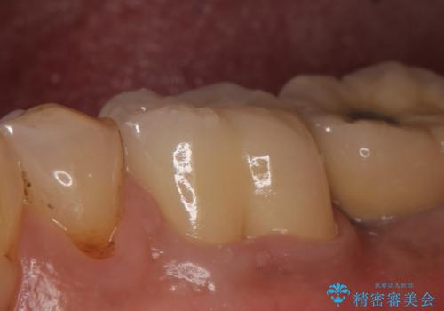 オールセラミッククラウン 咬むと痛む奥歯の根管治療の症例 治療後