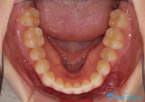 気になる前歯を整えたい インビザライン・ライトでの矯正治療の治療前