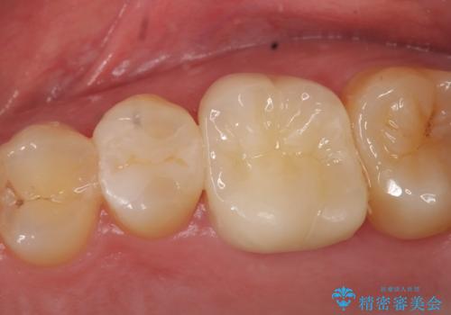 セラミック治療　痛くて咬めない奥歯の治療の治療後