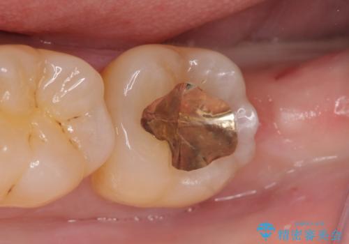 PGA(ゴールド)インレー 冷たいものがしみる歯の治療の症例 治療後