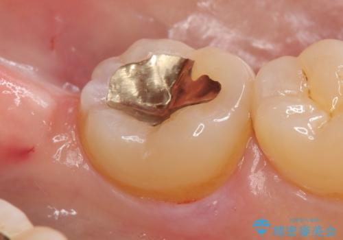 PGA(ゴールド)インレー 冷たいものがしみる歯の治療の治療後