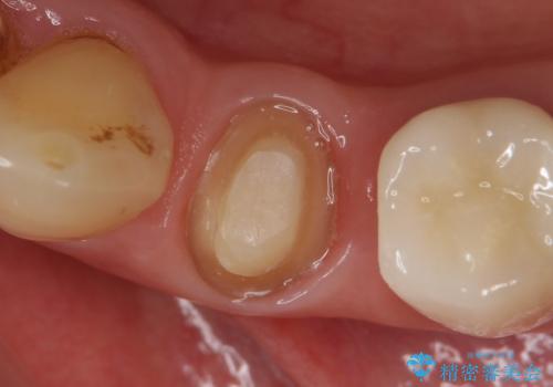 オールセラミッククラウン ズキズキ痛む歯の治療の治療中
