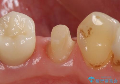 オールセラミッククラウン ズキズキ痛む歯の治療の治療中