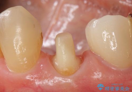 オールセラミッククラウン ズキズキ痛む歯の治療の治療中