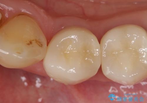 オールセラミッククラウン ズキズキ痛む歯の治療の症例 治療後