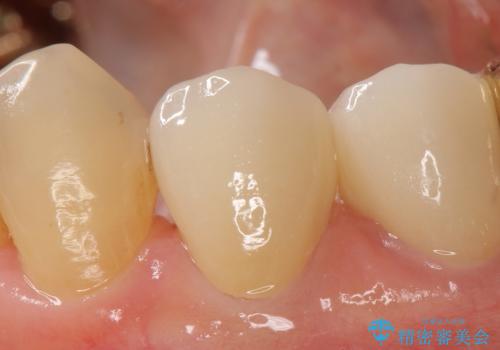 オールセラミッククラウン ズキズキ痛む歯の治療の治療後