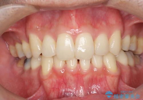 加齢による歯の黄ばみを、オフィスホワイトニングで白く。の症例 治療前