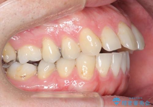 出っ歯　すれ違い咬合の改善　の治療前