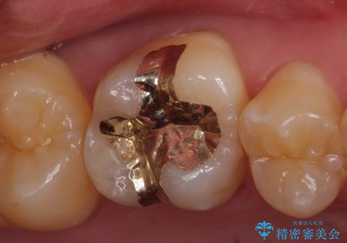PGA(ゴールド)インレー 欠けた古い樹脂のやり替えの治療後