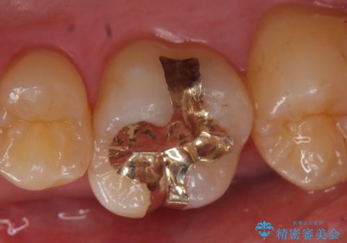 PGA(ゴールド)インレー 欠けた古い樹脂のやり替えの症例 治療後