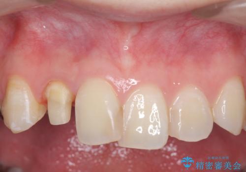 オールセラミッククラウン 被せ物の継ぎ目が気になるの治療中
