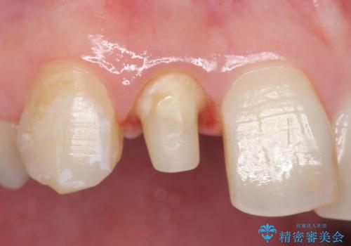 オールセラミッククラウン 被せ物の継ぎ目が気になるの治療中