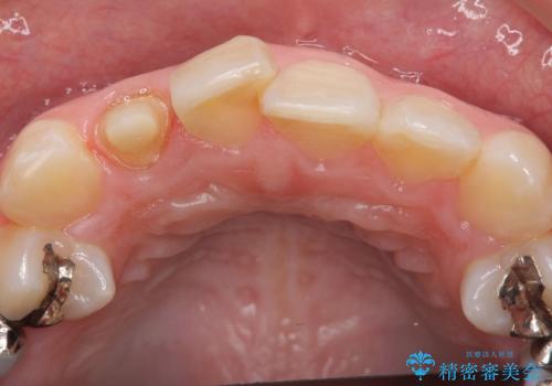オールセラミッククラウン 被せ物の継ぎ目が気になるの治療中