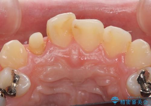 オールセラミッククラウン 被せ物の継ぎ目が気になるの治療中