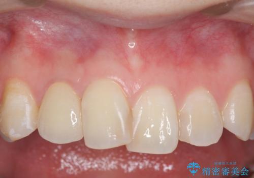 オールセラミッククラウン 被せ物の継ぎ目が気になるの症例 治療後