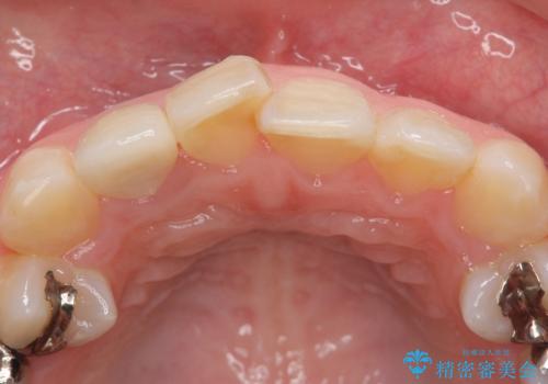 オールセラミッククラウン 被せ物の継ぎ目が気になるの治療後