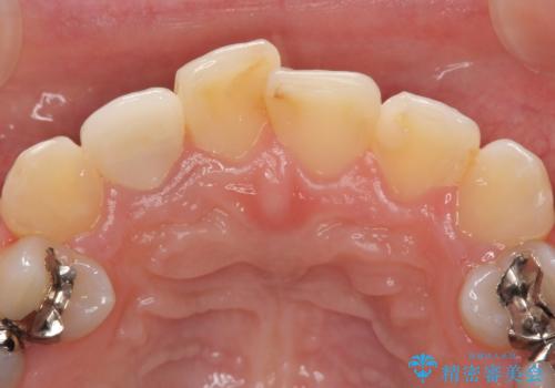 オールセラミッククラウン 被せ物の継ぎ目が気になるの治療後
