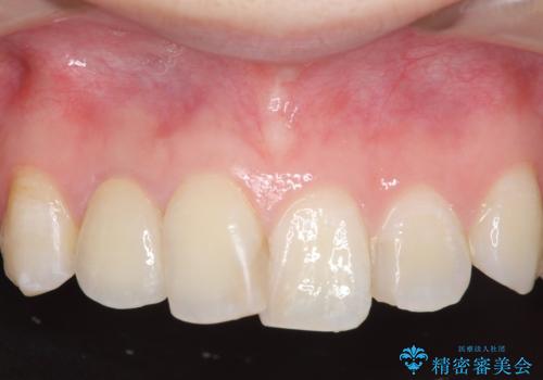 オールセラミッククラウン 被せ物の継ぎ目が気になるの治療後