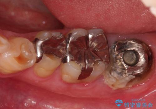 【ヘミセクション】なんとか残したい、割れた奥歯。の症例 治療前