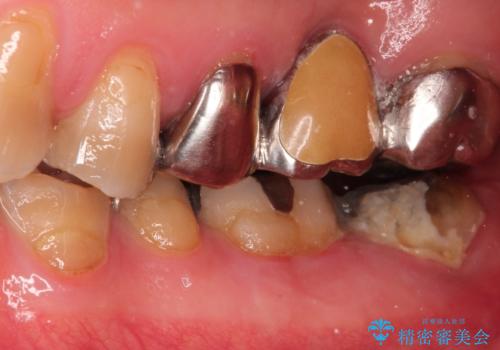 【ヘミセクション】なんとか残したい、割れた奥歯。の治療前