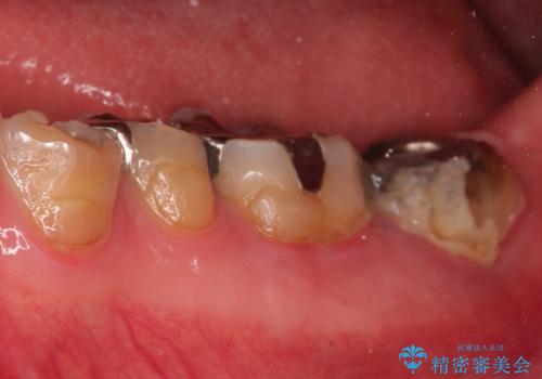 【ヘミセクション】なんとか残したい、割れた奥歯。の治療前