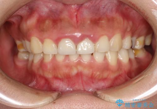 矯正治療を考えている方のクリーニングの治療前