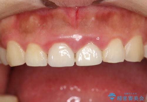 矯正治療を考えている方のクリーニングの治療前