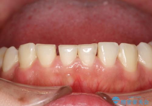 矯正治療を考えている方のクリーニングの治療前