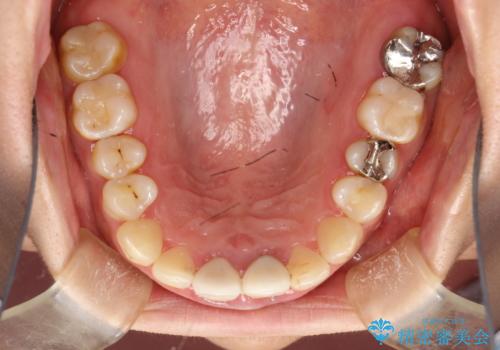 矯正治療を考えている方のクリーニングの治療前