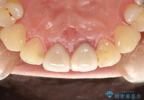 矯正治療を考えている方のクリーニングの治療前