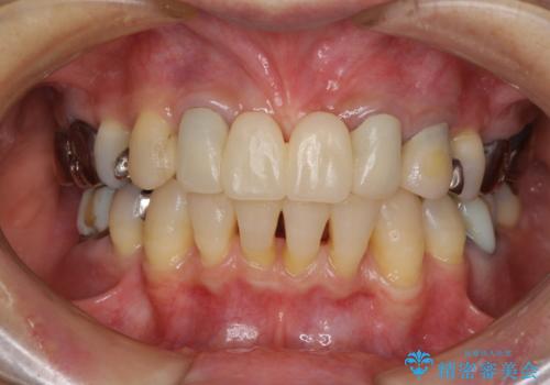 話しにくく腫れやすい前歯のブリッジ 使用感の良いオールセラミックブリッジにの治療前