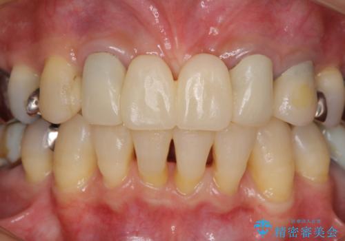話しにくく腫れやすい前歯のブリッジ　使用感の良いオールセラミックブリッジにの治療前