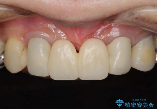話しにくく腫れやすい前歯のブリッジ　使用感の良いオールセラミックブリッジにの症例 治療前